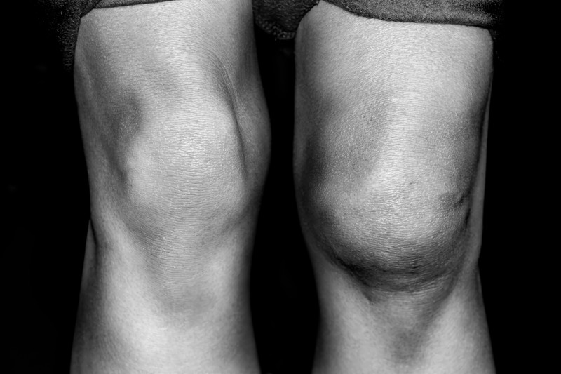 Swelling In Knee: Symptom, Causes, and Treatment